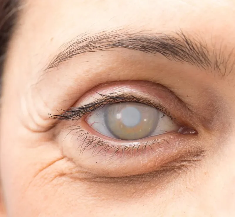 Opération de la cataracte à Tanger réalisée au cabinet du Dr Soukaina Boussena, ophtalmologue