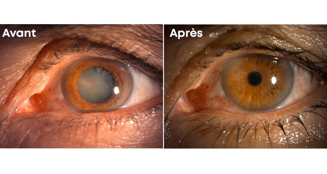 Photo avant et après une opération de la cataracte au cabinet du Dr Soukaina Boussena à Tanger